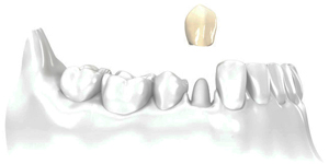 Perfect Smile all ceramic crown